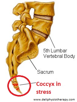 coccydynia coccydynia